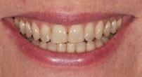 Dental Dynamics Featured Case - Smile Prior to Receiving Dental Veneers