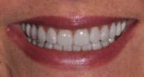 Prior to Receiving Dental Veneers, Dental Dynamics Featured Case