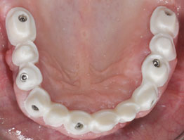 Dental Dynamics Featured Case - Full Mouth Dental Implants