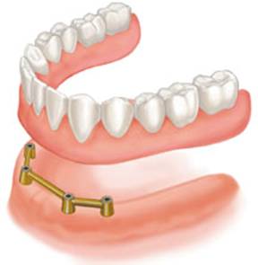 Bar Implant Dentures