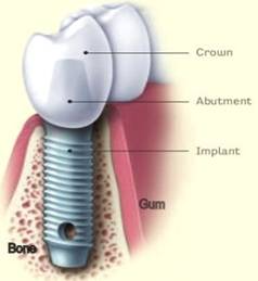 Dental Implant with related components