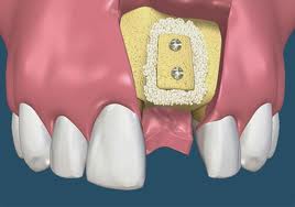 After Dental Ridge Augmentation