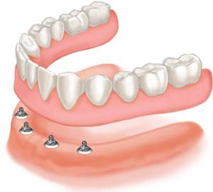 Dentures supported by Four Implants