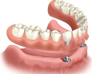 Dentures Supported by Two Dental Implants