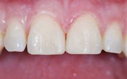 Direct Composite Veneer After