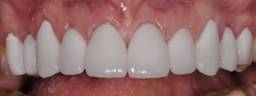 After Emax dental veneers, Dental Dynamics, Portland, Oregon