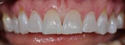 Before Emax dental veneers, Dental Dynamics, Portland, Or