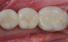 After Implant Bridge