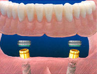 Locator Attachment Implant Denture