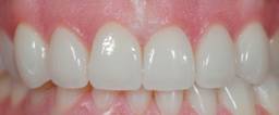 After ultra-thin dental veneers, Dental Dynamics, Portland, OR