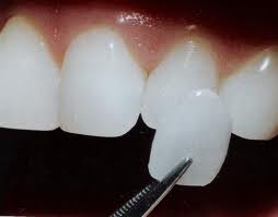 Ultra Thin Dental Veneers