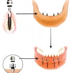 Dentures Supported by Mini Dental Implant, Dental Dynamics, Portland, Oregon