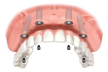 Four Dental Implants