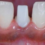 Immediate Dental Implants with Final Restoration, Dental Dynamics, Portland, Oregon