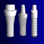 Metal Free Dental Implants, Dental Dynamics, Portland, Oregon