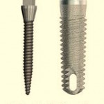 Mini Dental Implant Illustration